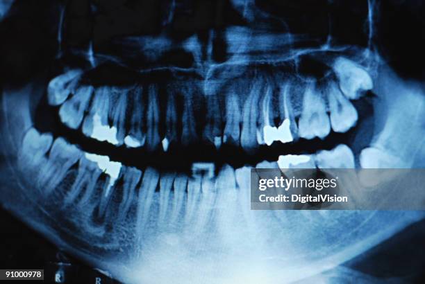 dental x-ray - human teeth stock pictures, royalty-free photos & images