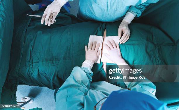 overhead view of surgeons performing operation on abdomen in maternity ward operating theatre - operationstisch stock-fotos und bilder