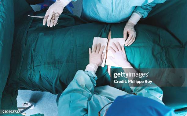 overhead view of surgeons performing operation on abdomen in maternity ward operating theatre - operating table stock pictures, royalty-free photos & images