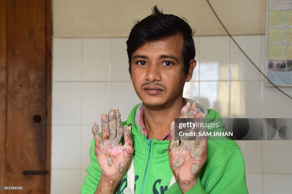 TOPSHOT-BANGLADESH-HEALTH-TREEMAN