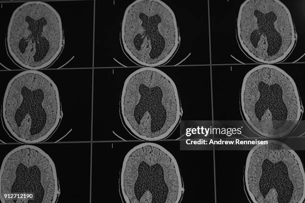 Excess fluid is seen in a CT scan of a brain at Cure Children's Hospital on February 2, 2017 in Mbale, Uganda. The hospital owns one of two CT scan...