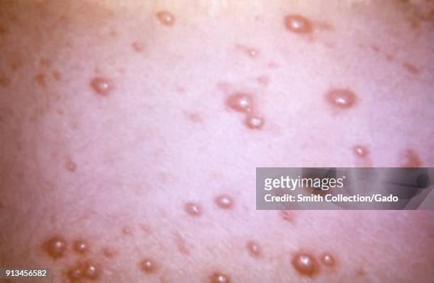 Herpesviridae chickenpox caused pustulovesicular rash on the skin due to the Varicella-zoster virus , 1966. Image courtesy Centers for Disease...