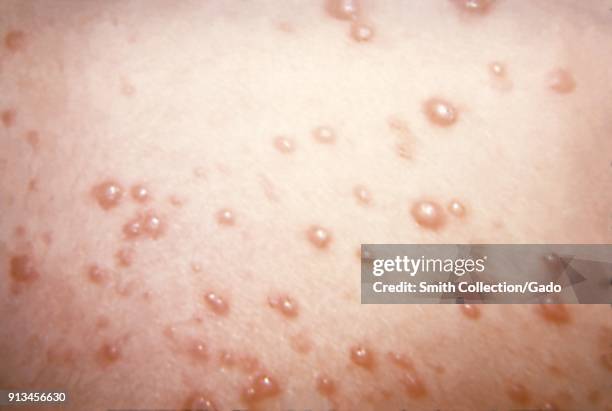 Varicell Raction Rash Skin Rash Photos Imagens e fotografias de stock - Getty Images