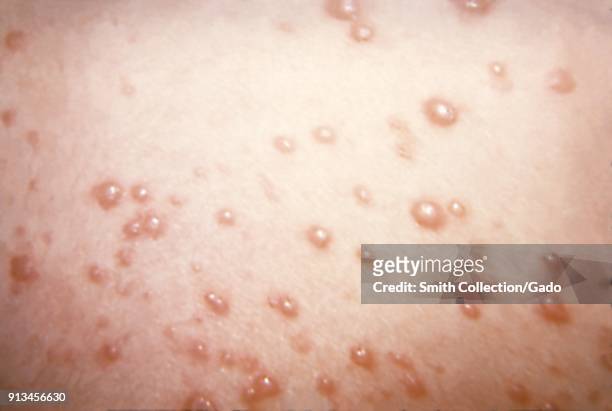Herpesviridae chickenpox caused pustulovesicular rash on the skin due to the Varicella-zoster virus , 1975. Image courtesy Centers for Disease...