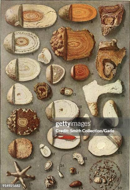 Color illustration depicting 30 numbered examples of kidney and bladder stones, some in cross-section, from the volume 'Diseases of the Kidneys,...
