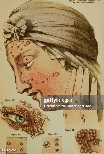 Color illustration depicting smallpox pustules, shown on the face and hand of a woman, in profile, wearing a scarf, with inset close-ups to...