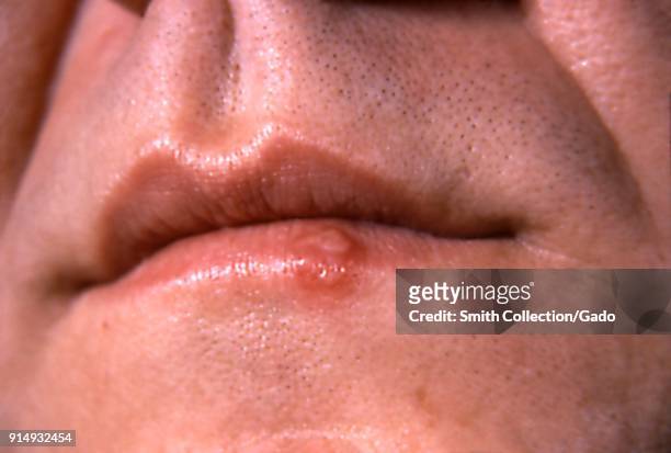 Close-up photograph of a cold sore caused by the Herpes simplex virus, on the lower lip, 1964.