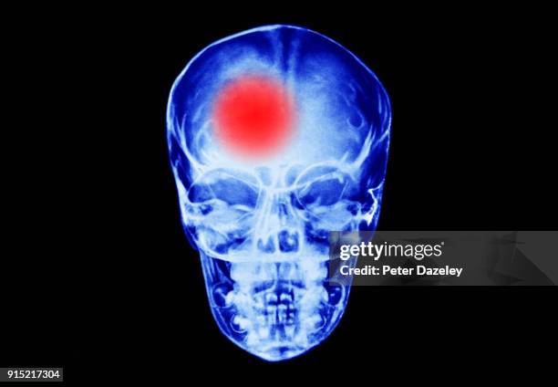 senior man having a stroke tumour - hersenbloeding stockfoto's en -beelden