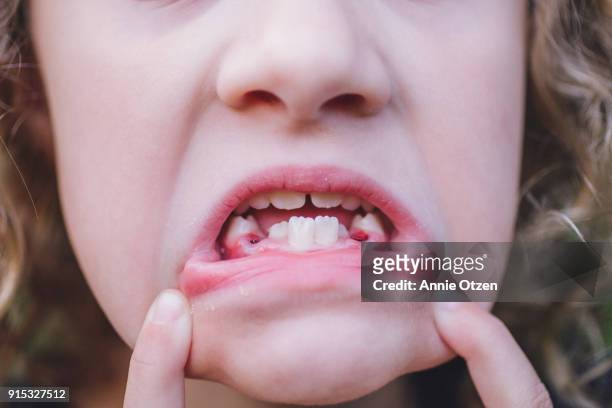 Girl showing Mouth with teeth missing