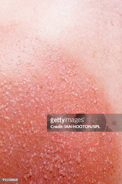 sunburned skin on man's shoulders, close-up - sunburned stock pictures, royalty-free photos & images