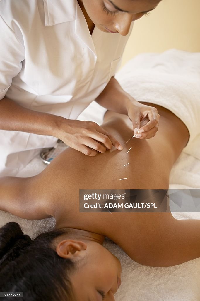 Acupuncture