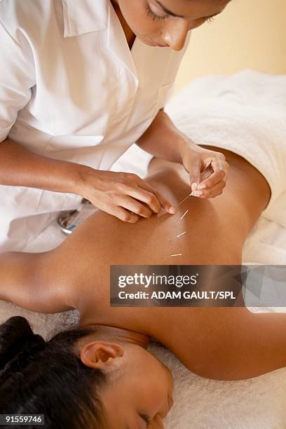 acupuncture - acupuncture needle stock pictures, royalty-free photos & images
