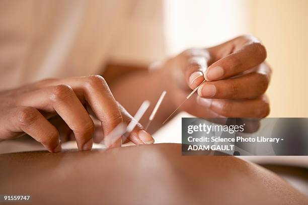 acupuncture - acupuncture stockfoto's en -beelden