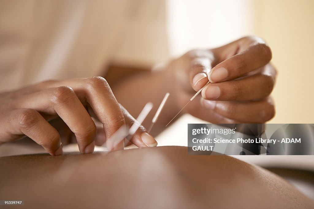 Acupuncture