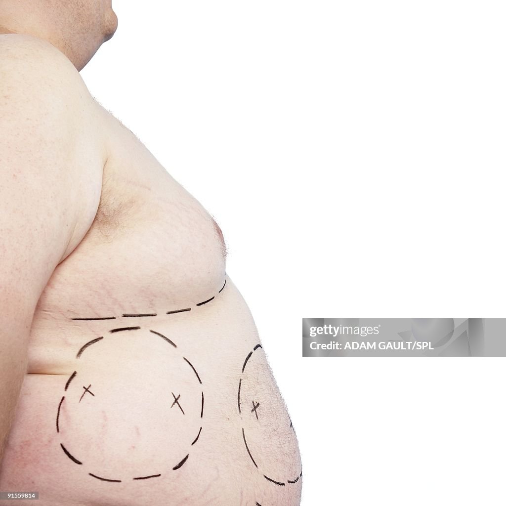 Areas of excess fat marked for liposuction