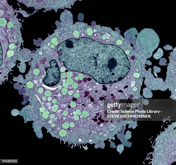 illustrations, cliparts, dessins animés et icônes de carcinoma cell, colored transmission electron micrograph (tem) - cellule cancéreuse