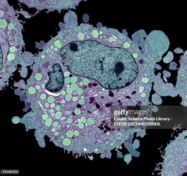 carcinoma cell, colored transmission electron micrograph (tem) - tem 幅插畫檔、美工圖案、卡通及圖標