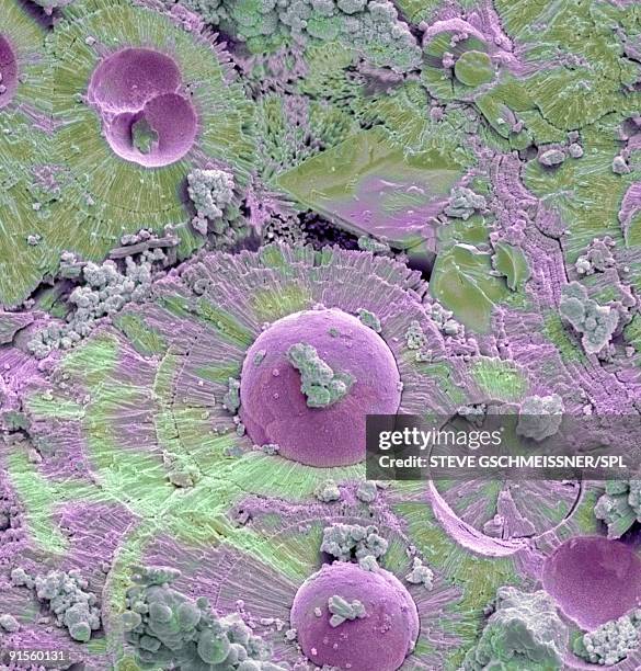 bladder stone - scanning electron microscope stock illustrations