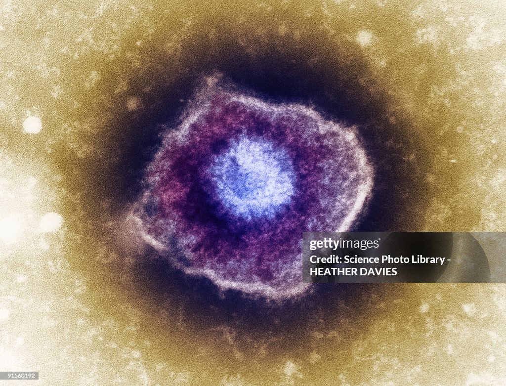 Varicella zoster virus (VZV) particle, colored transmission electron micrograph (TEM)