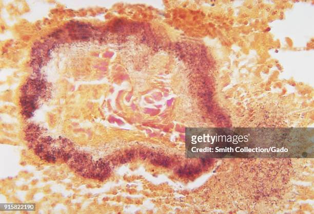 Histopathologic appearance of an actinomycetic mycetomatous granule caused by Gram-positive rod-shaped bacteria Propionibacterium propionicus, 1972....