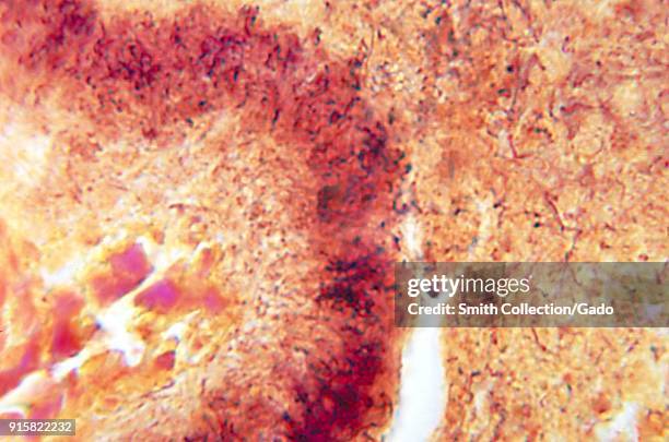 Histopathologic appearance of an actinomycetic mycetomatous granule caused by gram-positive rod-shaped bacteria Propionibacterium propionicus, 1972....