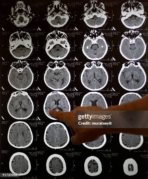 brain tomography - hemorrhage stock pictures, royalty-free photos & images