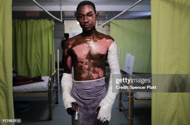 Shnider Avril, who was severly burned by an explosion from a propane tank, poses in the Medecins Sans Frontires/Doctors Without Borders Drouillard...