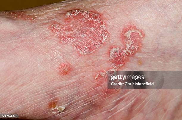 Psoriasis Photos and Premium High Res Pictures - Getty Images