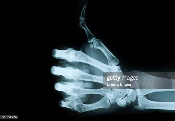 x-ray view of hand giving no a thumbs up - röntgen stockfoto's en -beelden