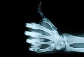 X-ray view of hand giving no a thumbs up
