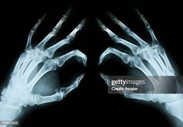 normal una radiografía de la mano humana - radiogram photographic image fotografías e imágenes de stock