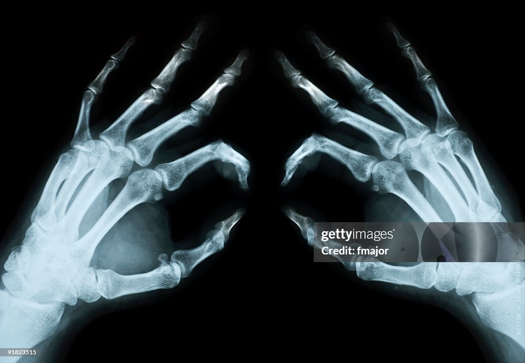 Burn Hand Radiograph Radiopaedia Normal Left Hand X Ray