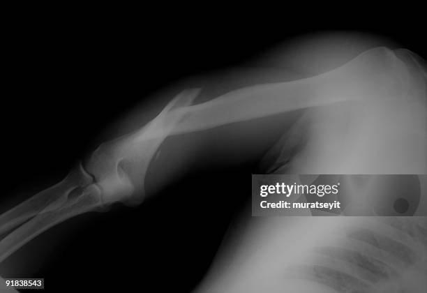 brazo fracturado rayos x - upper arm bone fotografías e imágenes de stock