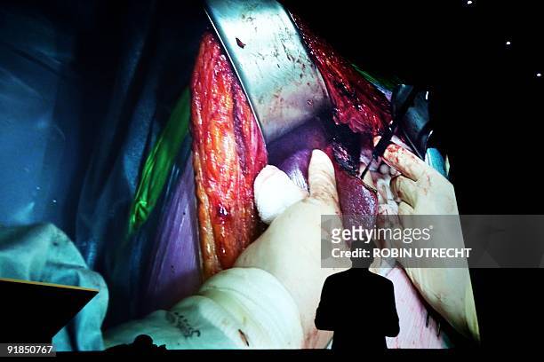 Spectators watch live liver surgery to remove a tumor at the Pathe cinema in Rotterdam on October 13, 2009. The surgery was filmed by a video...