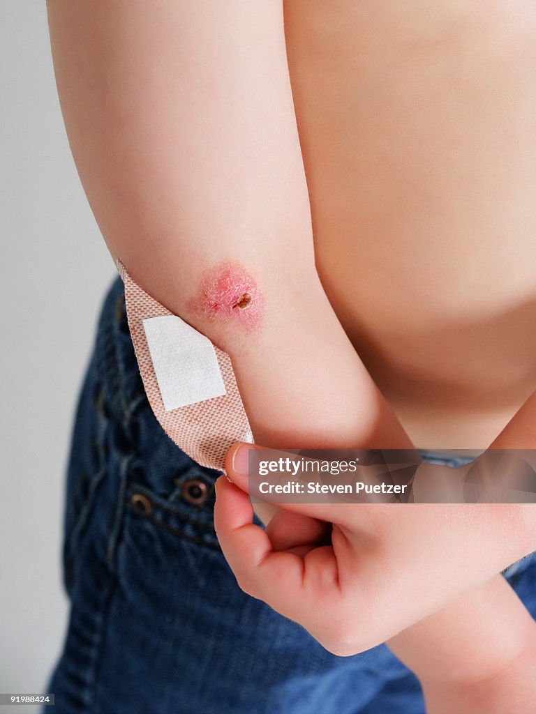 Boy peeling back bandage revealing scab