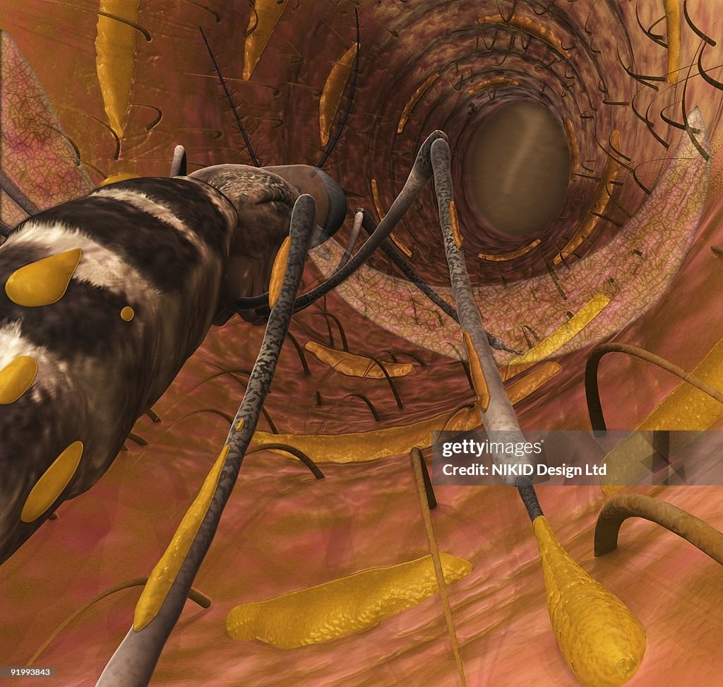 Fly In Ear Digital Illustration Of Mosquito Crawling Inside Human Ear Canal Lined ...