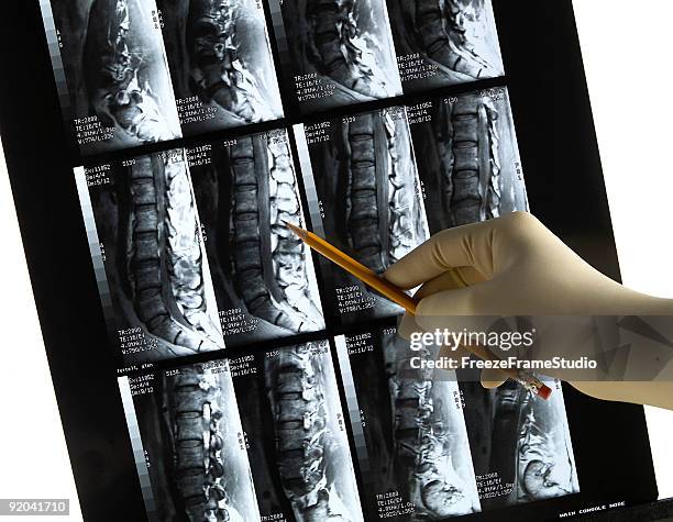 lower back mri scan with gloved physician's hand & pencil - hernia stockfoto's en -beelden