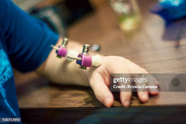 man suffering from broken wrist and arm with titanium external fixator - surgical pin stock pictures, royalty-free photos & images