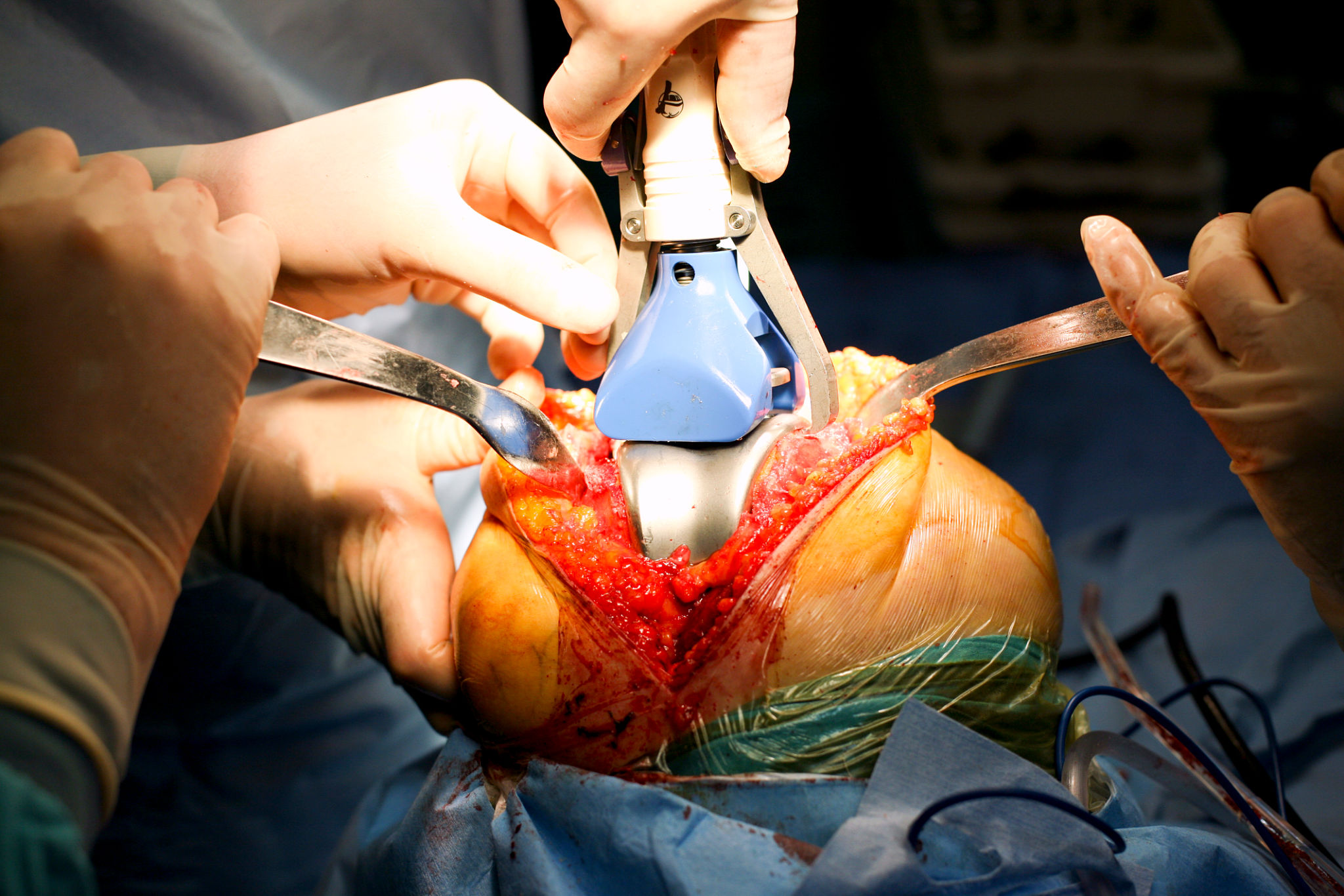 bone graft surgery