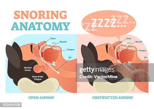 Snoring Types Snoring Anatomy Medical Vector Diagram With Air Passage High-Res Vector ...