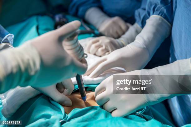 doctors in scrubs operating on a patient using instruments - surgical pin stock pictures, royalty-free photos & images