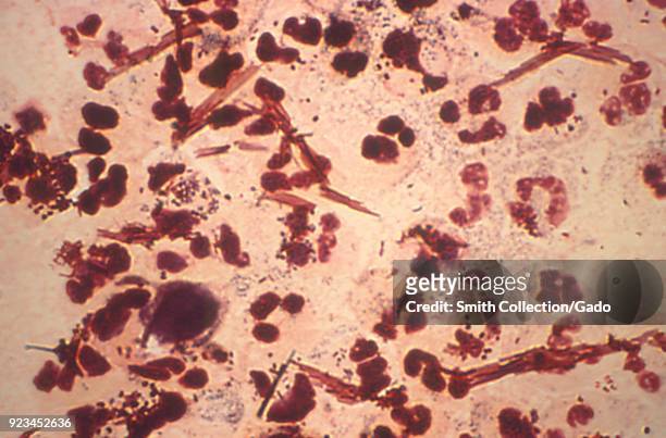 Neisseria gonorrhoeae bacteria revealed in the gram-stain image of a urethral discharge specimen, 1975. Image courtesy Centers for Disease Control /...