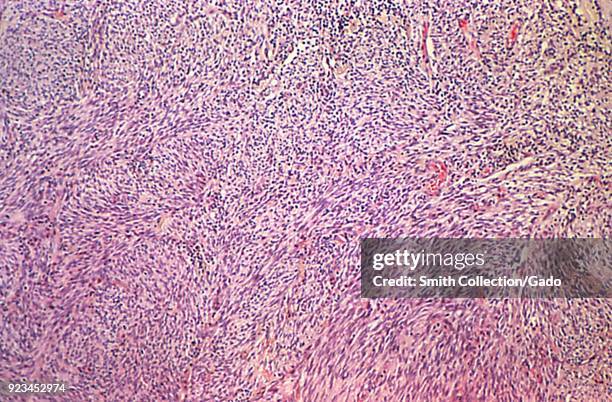 Cytoarchitectural signs of Kaposi's sarcoma revealed in the photomicrograph of a skin biopsy, 1980. Image courtesy Centers for Disease Control / Dr...