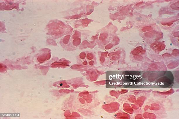 Neisseria gonorrhea Gram-negative intracellular rods revealed in the photomicrograph of the urethral discharge, 1975. Image courtesy Centers for...