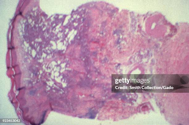 Kaposi's sarcoma in human skin revealed in the low magnification photomicrograph film, 1983. Image courtesy Centers for Disease Control / Dr Peter...