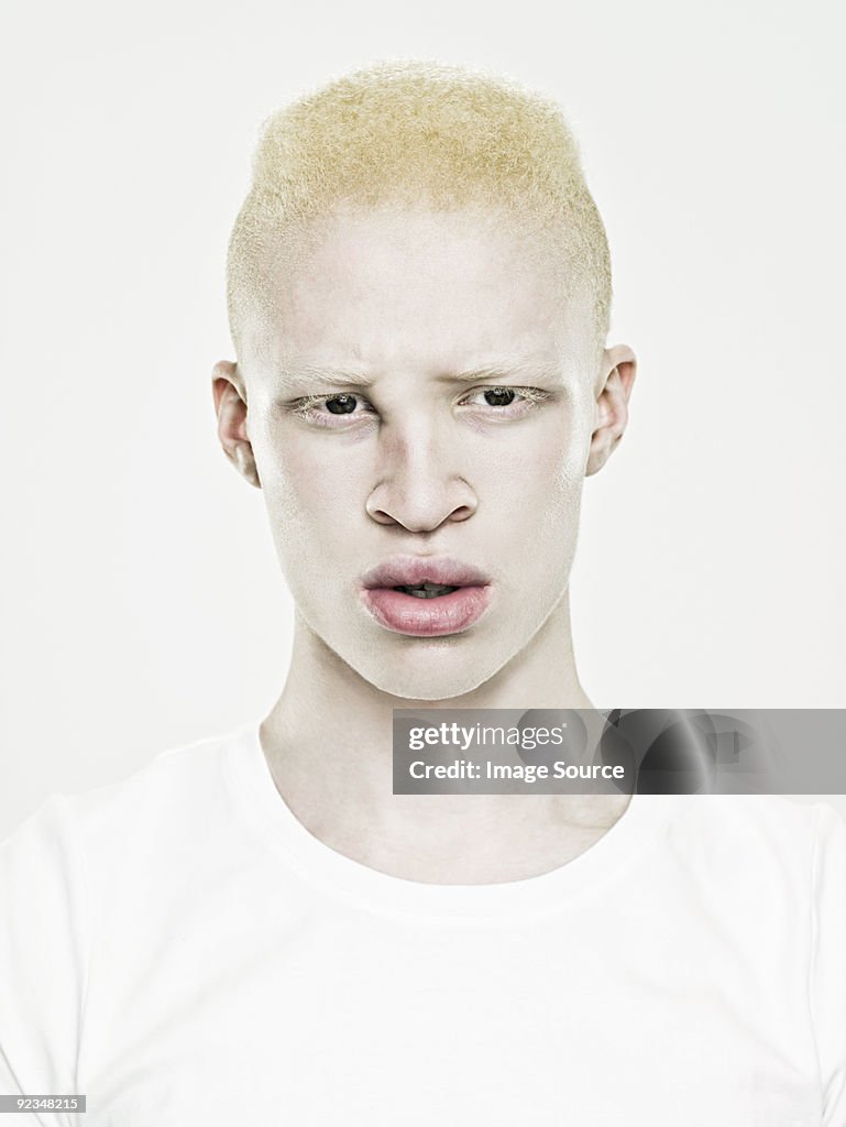 Photo Dun Jeune Homme Albinos Photo - Getty Images