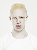 Headshot of a young albino man