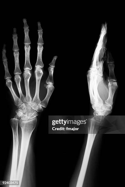 weibliche hand mit osteoporose - röntgenaufnahme stock-fotos und bilder