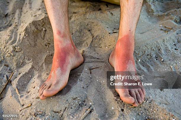 very sunburned feet - sunburned stockfoto's en -beelden