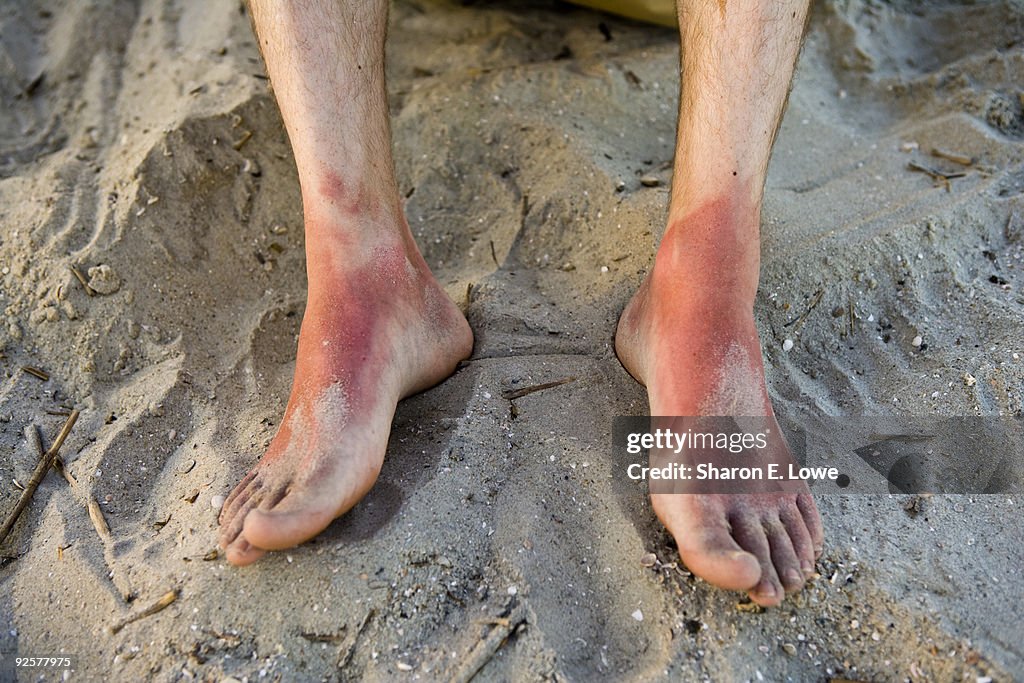 Very Sunburned Feet